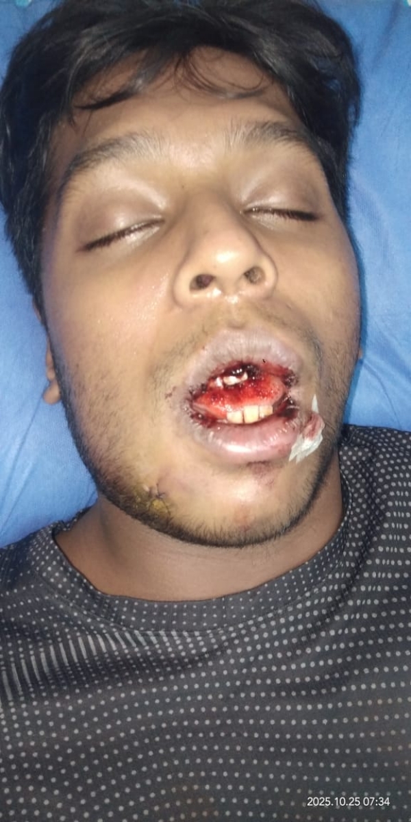 “Clash during football match: Jaw fractured, victim hospitalized for treatment – Police register a case and begin investigation!”